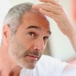 Причины выпадения волос у мужчин